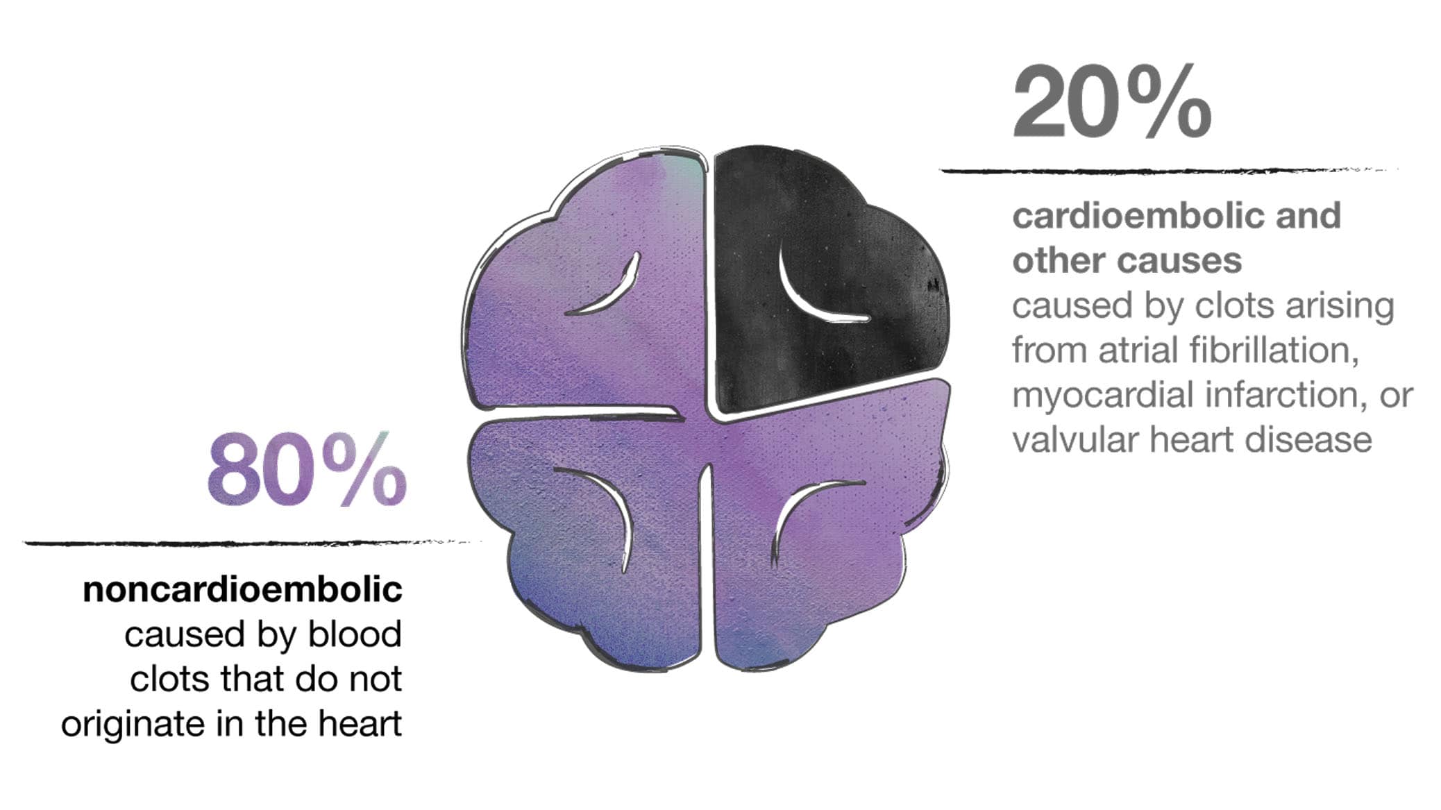 Graphic showing a brain illustration divided into four sections with text indicating 80% noncardioembolic strokes caused by clots that do not originate in the heart and 20% cardioembolic and other causes caused by clots arising from atrial fibrillation, myocardial infarction, or valvular heart disease.
